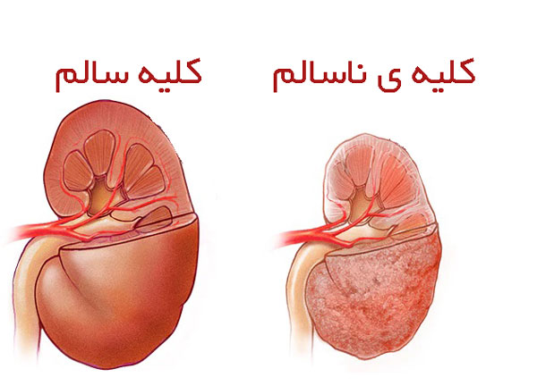 نارسایی کلیه